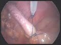 Laparoscopic appendicectomy (uncut, easy) Laparoscopic appendicectomy (uncut, easy)