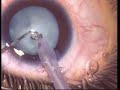 Phaco in developmental cat with PC polishing