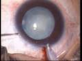 Phaco in developmental cat with PC polishing