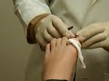 Ingrown Toenail Removeal Part 2