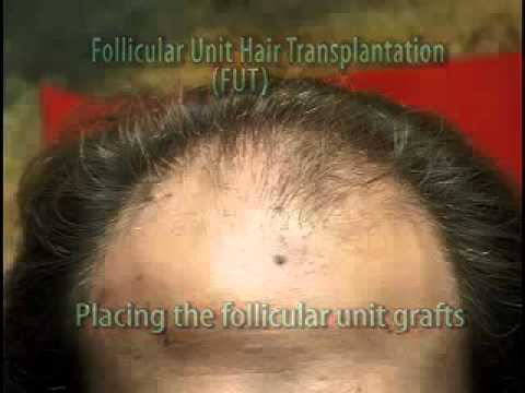how to sleep after hair transplant