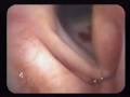 Vocal Cord Medialization by Injection for Vocal Cord Paralysis