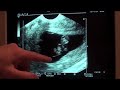 IVF: Ultrasound Week 9