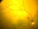 two port surgery of epimacular membrane.mpg two port surgery of epimacular membrane.mpg