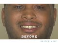 BriteSmile Teeth Whitening Experience