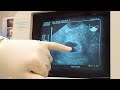 Pregnancy ultrasound at 7 weeks 2 days.MOV