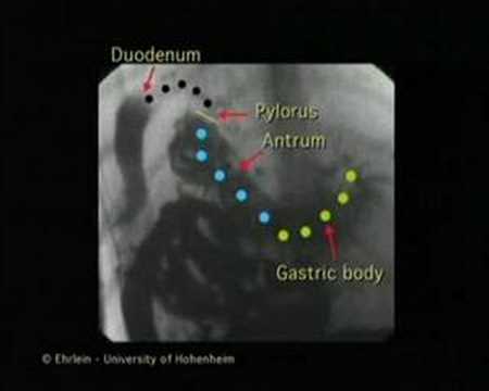 Upper GI Movies - Stomach Peristalsis