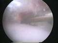 Impingement Syndrome
