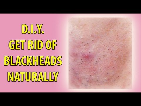 DIY Treatment for Blackheads/Acne