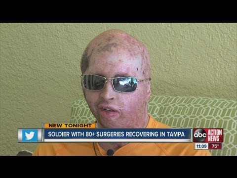 Iraq - Second most wounded Iraq soldier recovering in Tampa.