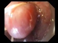 Esophageal Variceal Ligation Esophageal Variceal Ligation