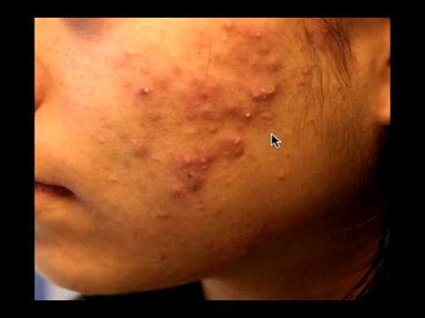 The Acne Practice  (Severe Teenage Acne)