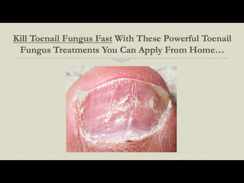 how to kill toenail fungus quickly