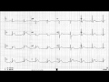 CCRN Study Tip: Where MI's are on EKG's