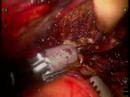 RoboticAssistedProstateCerrahisi