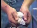 Application of Short Arm Plaster Cast SAC