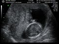 3D Ultrasound//Gender- 16 Weeks
