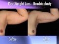 Dr. Nachbar on post-weight loss surgery