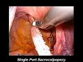 Single Port Surgery with Autonomy Laparo-Angle Instruments Single Port Surgery with Autonomy Laparo-Angle Instruments