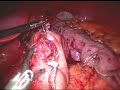 Laparoscopic Duodenal Switch Laparoscopic Duodenal Switch