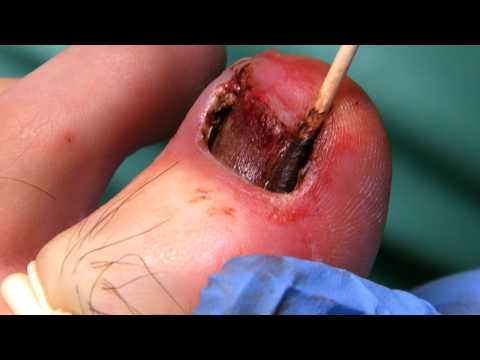 how to kill fungus in boots