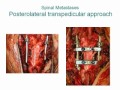 Posterior Vertebrectomy for Metastic High Thoracic Tumors