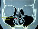 Understand why your nose is blocked