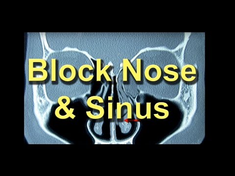 how to unclog ethmoid sinus