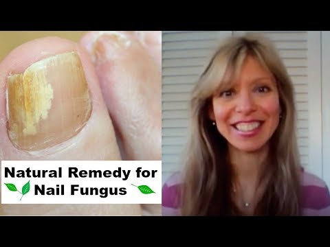 how to treat fungus hands