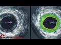 Insidermedicine in 60 - April 22, 2008  Cholesterol Heart and Circulation