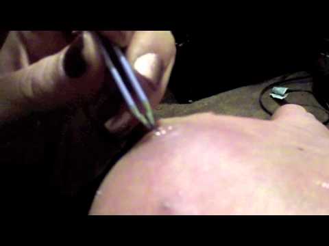 how to remove a splinter nhs