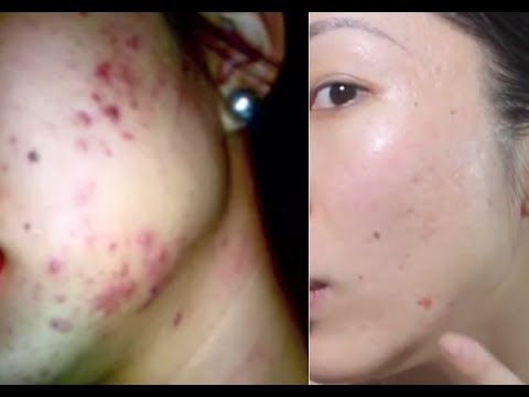 HOW TO REMOVE ACNE SCARS FOR UNDER $60!!!