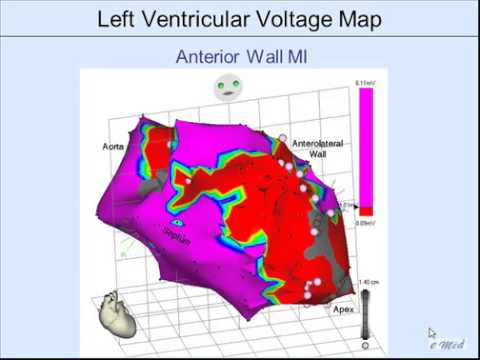 how to perform vt ablation