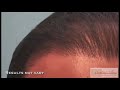 Fue repair of a juri hair flap hairline by dr umar