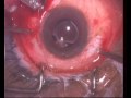 Primary Vitrectomy + Retinal Detachment Virectomy + Membrane Peel + Silicone Oil + Cryo_Part2.flv
