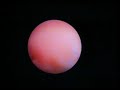 Spyglass biopsy Spyglass biopsy