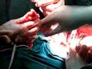 Laringectomía total en Ca Epidermoide de laringe