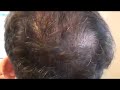1000 grafts, hair transplant crown work