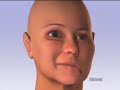 Injerto de músculo para curar la parálisis facial Injerto de músculo para curar la parálisis facial