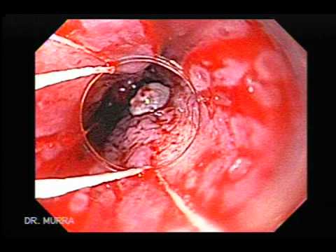 how to cure esophageal ulcers