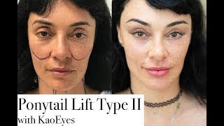 Ponytail Lift™ Type II with KaoEyes. KAO Plastic Surgery Facelift Before And After Video