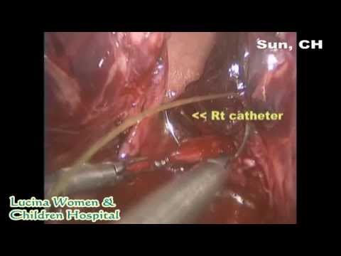how to repair uterine rupture