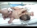 Conjoined Twins