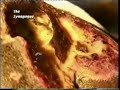 Cancer of the Buttock be healed in the name of Jesus Christ Cancer of the Buttock be healed in the name of Jesus Christ