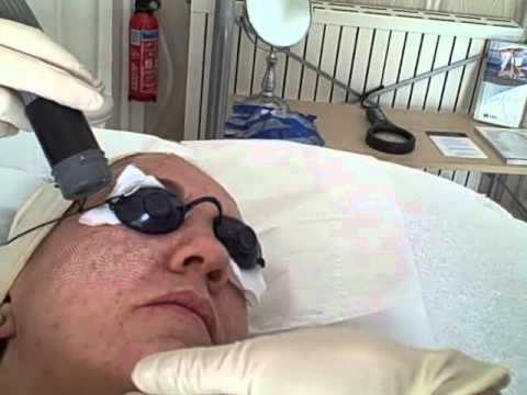 how to treat acne uk