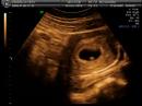 Primeira Ecografia do Baby Primeira Ecografia do Baby