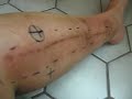 Radiation Therapy on Leg