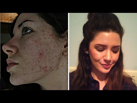 how to prevent acne on test e