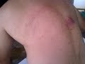 I almost Barfed popping this huge pimple