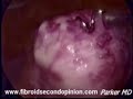 Laparoscopic Myomectomy
